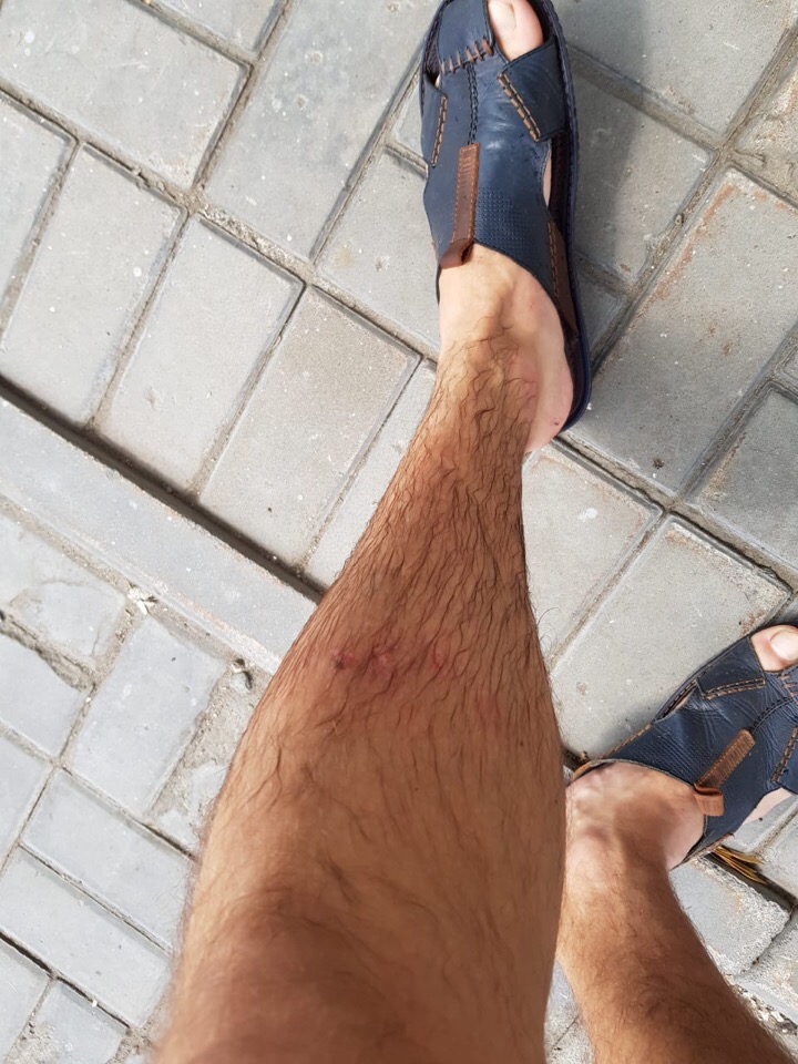 Травма после попадания в яму с водой.jpg