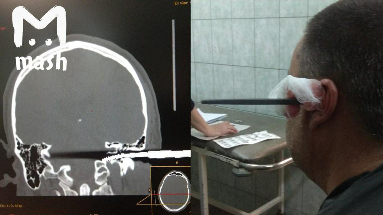 Саратовец воткнул себе в голову напильник.jpg