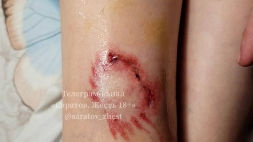 В Саратове бездомная собака укусила ребенка