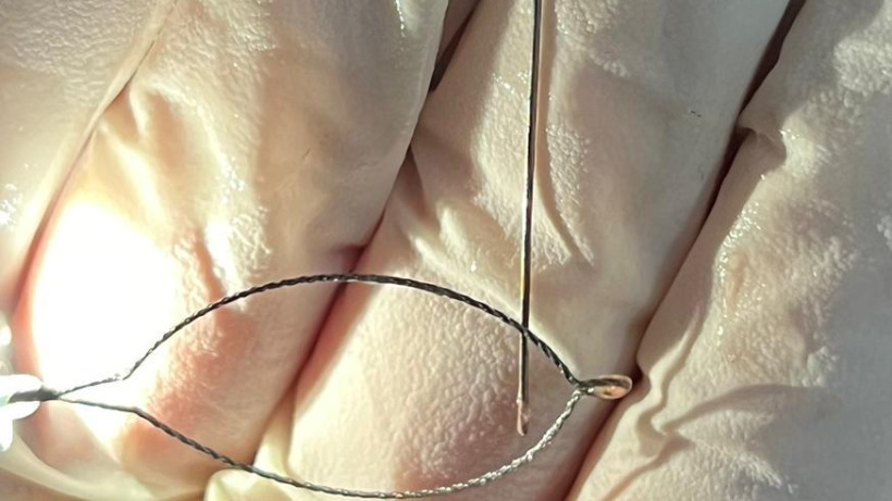 Энгельсские врачи извлекли из желудка женщины трехсантиметровую швейную иглу