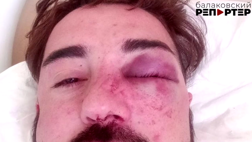 В балаковском ночном клубе азербайджанцу разбили лицо. Он считает, что нападение произошло после слов в поддержку спецоперации